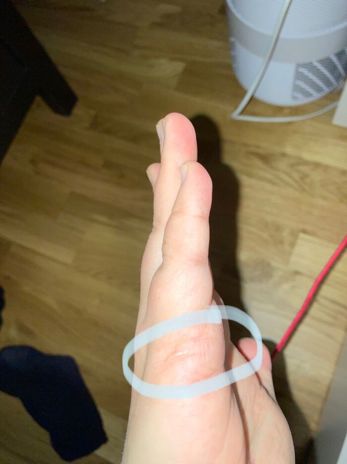 I Stuffed My Hand In A Pipe For Tennis Balls And Sliced Around My Hand On The Aluminium Edge