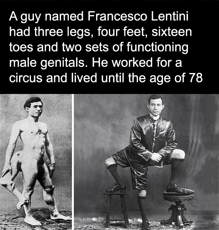 Black and white photo of Francesco Lentini with three legs, a creepy fact from unusual medical history to deprive somebody of sleep.
