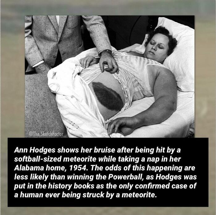 Black and white photo of Ann Hodges showing a bruise from a rare meteorite strike, highlighting disturbing and morbid facts.