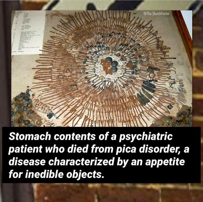 Stomach contents of a psychiatric patient with pica disorder showing disturbing and morbid facts of inedible objects ingested.