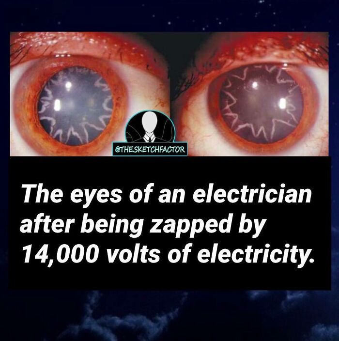 Close-up of eyes damaged after being zapped by 14,000 volts, illustrating disturbing and morbid facts that might freak you out.