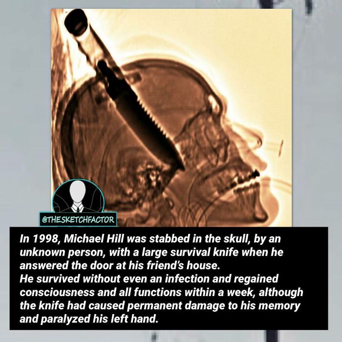 X-ray image showing a large survival knife lodged in a skull, illustrating disturbing and morbid facts.