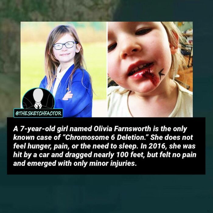 7-year-old girl with Chromosome 6 Deletion, a disturbing and morbid fact, showing minor injuries after serious accident.