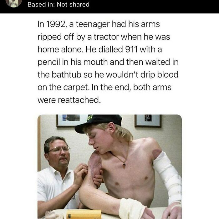 Teenager with reattached arms after tractor accident, illustrating one of the random creepy facts to deprive somebody of sleep.