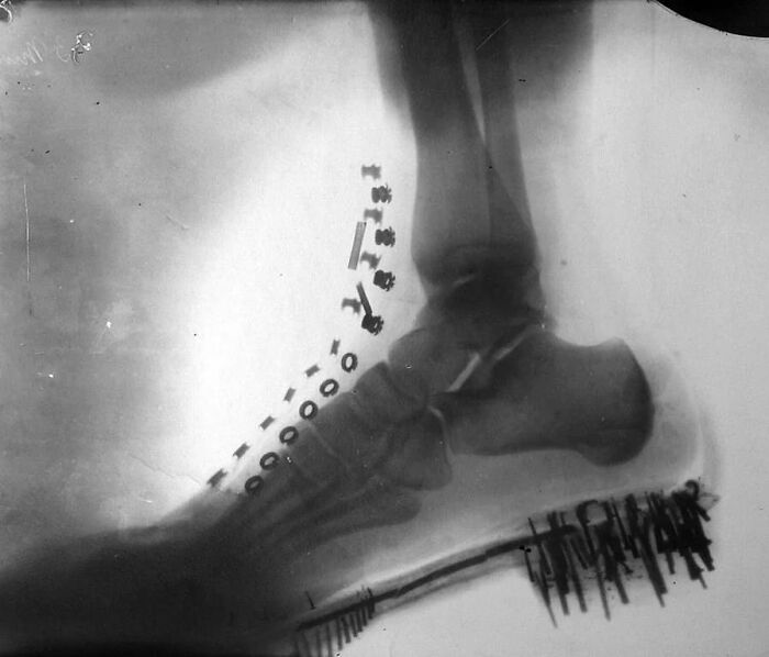 Nikola Tesla’s Foot X-Ray Taken By Himself On A Machine He Designed (1896)