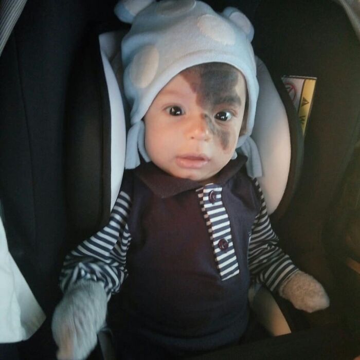 Societal Judgement Towards Enzo's Mark On His Face Encouraged His Mom To Replicate It On Hers To Walk In His Shoes