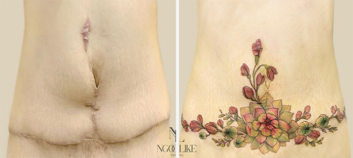 50 Times People Asked To Cover Up Their Scars, And This Tattoo Artist Nailed It (New Pics)