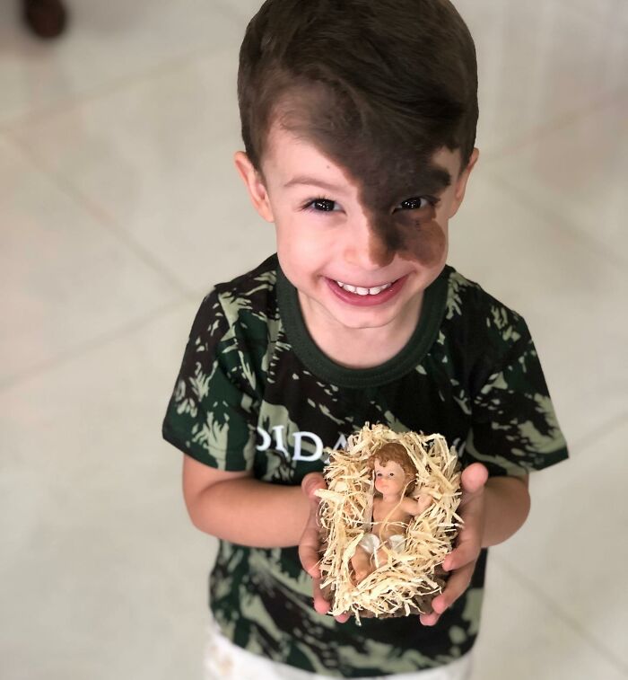 Societal Judgement Towards Enzo's Mark On His Face Encouraged His Mom To Replicate It On Hers To Walk In His Shoes