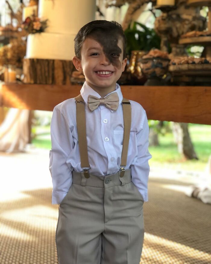 Societal Judgement Towards Enzo's Mark On His Face Encouraged His Mom To Replicate It On Hers To Walk In His Shoes