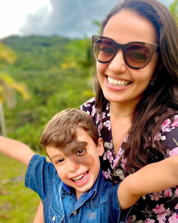 Societal Judgement Towards Enzo's Mark On His Face Encouraged His Mom To Replicate It On Hers To Walk In His Shoes