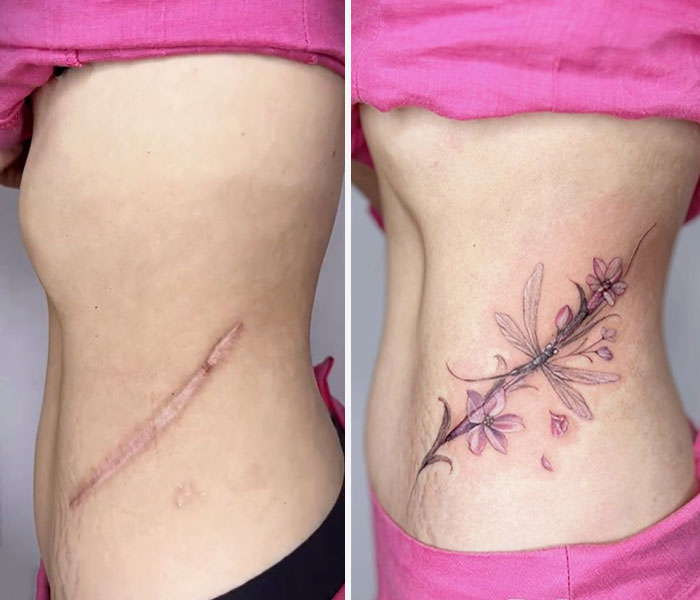 50 Times People Asked To Cover Up Their Scars, And This Tattoo Artist Nailed It (New Pics)