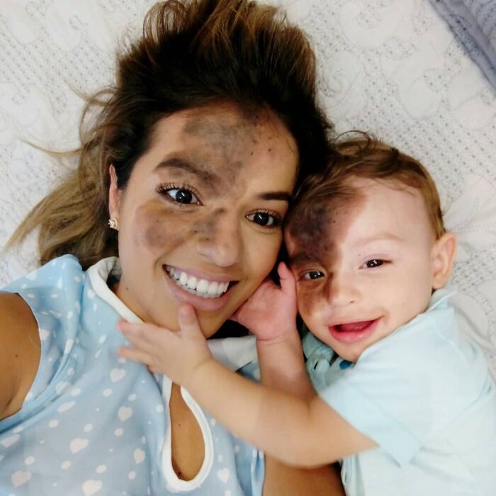 Societal Judgement Towards Enzo's Mark On His Face Encouraged His Mom To Replicate It On Hers To Walk In His Shoes