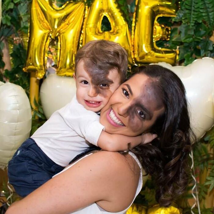Societal Judgement Towards Enzo's Mark On His Face Encouraged His Mom To Replicate It On Hers To Walk In His Shoes