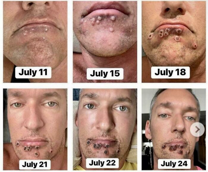 Progression Of Monkeypox