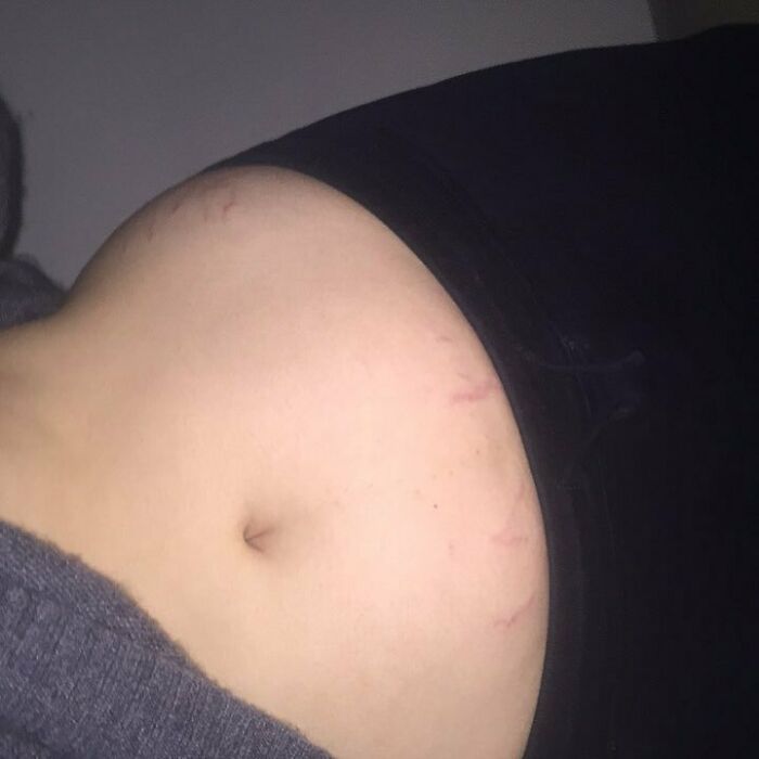 When Barbie Ferreira Posted This Photo Of Her "Lil Stripes" And Celebrated Just How Cute Her Body Is Because Of Them