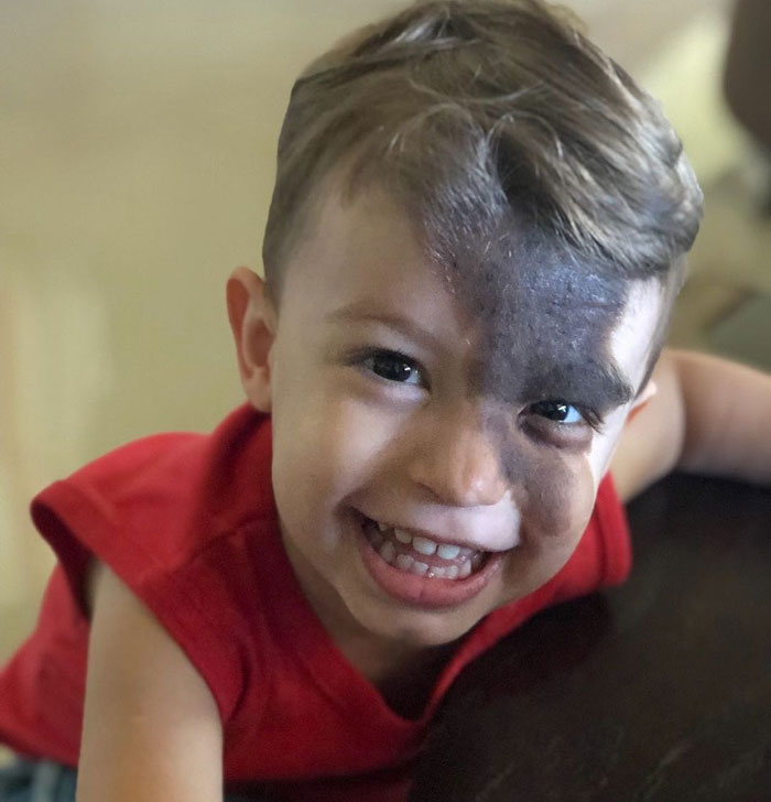 Societal Judgement Towards Enzo's Mark On His Face Encouraged His Mom To Replicate It On Hers To Walk In His Shoes