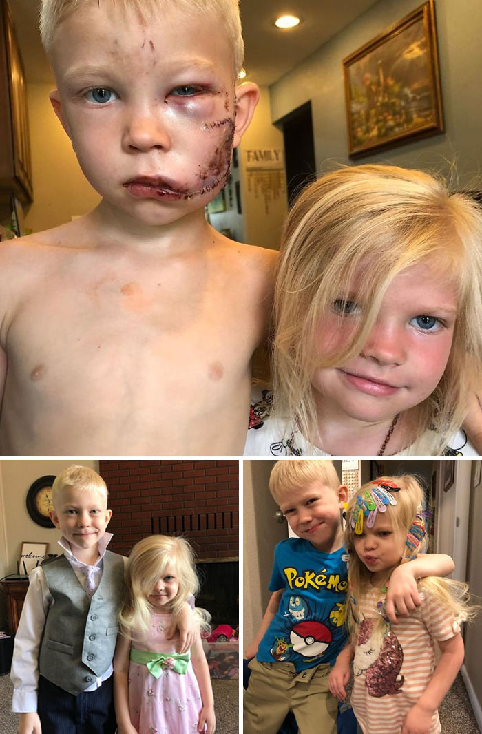 6-Year-Old Boy Protected His Little Sister From Dog Attack. He Stated, "If Anyone Has To Die, It's Me. I'm The Big Brother"