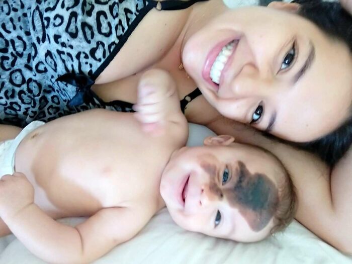 Societal Judgement Towards Enzo's Mark On His Face Encouraged His Mom To Replicate It On Hers To Walk In His Shoes