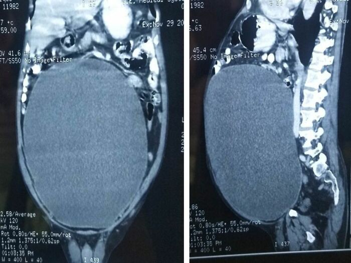 11l Of Urine Stored In A Bladder…