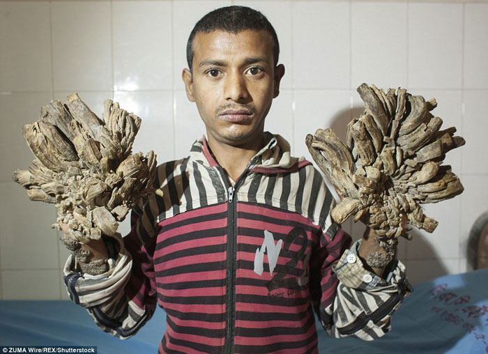 Epidermodysplasia verruciformis "Síndrome del hombre árbol"