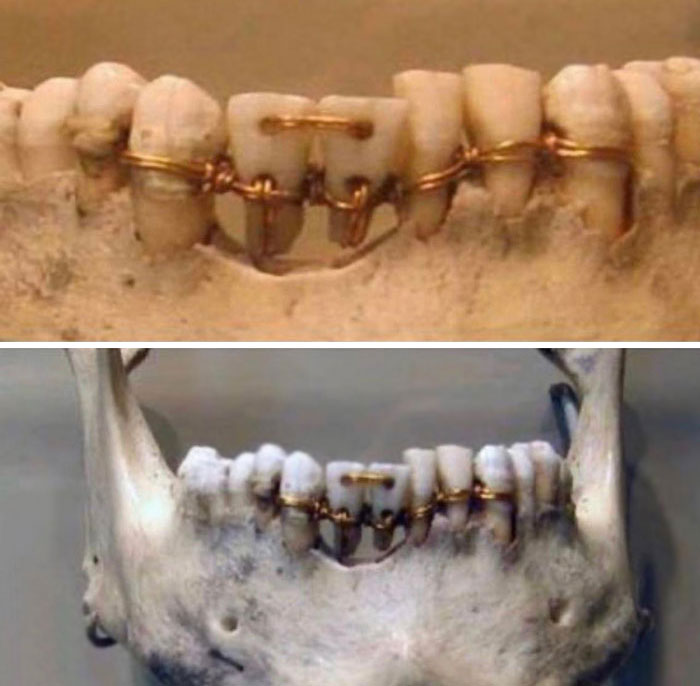 Ancient Egyptian Dental Work