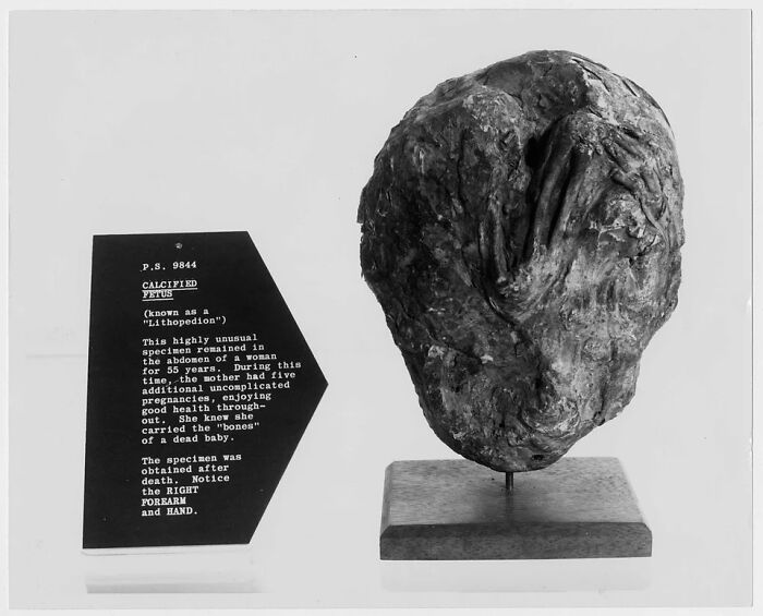 Woman Had A Calcified Fetus In Her For 55 Years