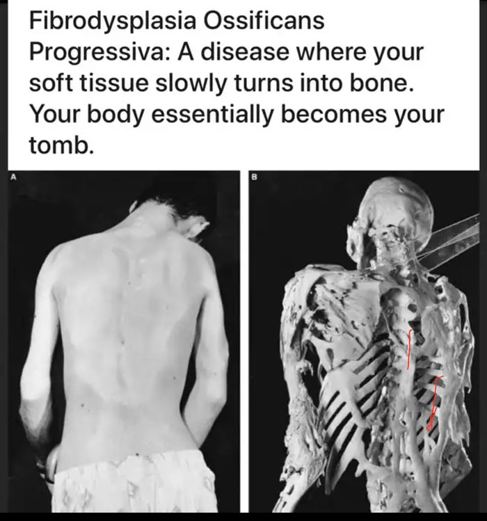Fibrodysplasia Offificans