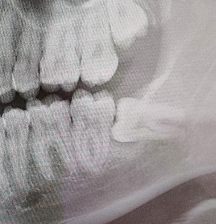 Found The Source Of My Toothache