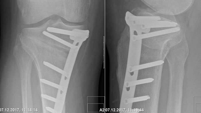 My Leg After Cutting It Off Under The Knee And Putting It Back Together With Titanium, You Can Still See The Cut Here. It Never Recovered Correctly Since My Body Rejected The Titanium And Nerve Damage But I Can Walk Again For A Little While At The Time At Least