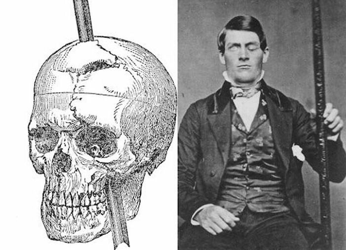 Phineas Gage. El hombre que sobrevivió a un hierro de apisonar en el cráneo. Más sobre él en la Sam O'Nella Academy