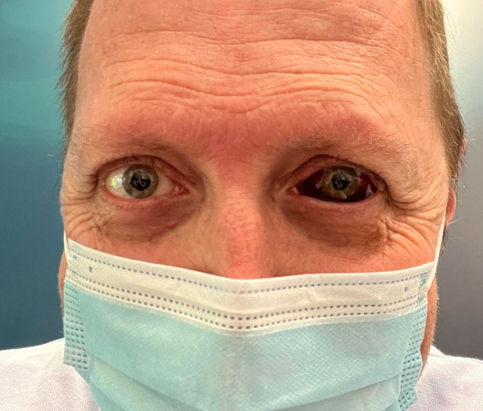 I Had An Eye Biopsy And Now I Look Like The Undead