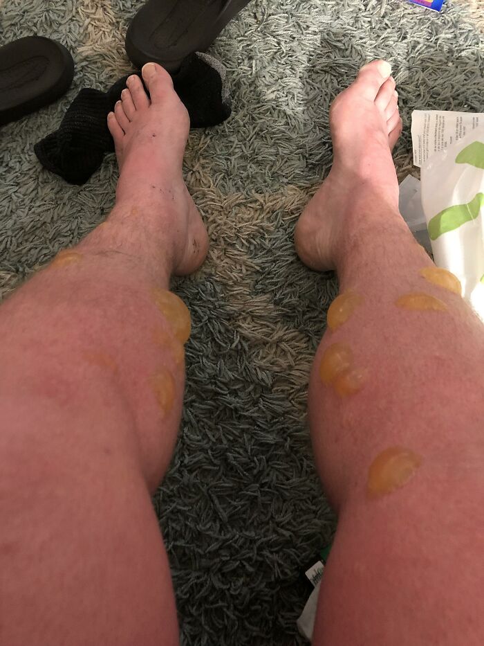 Be White Like Ghost, Float Down River For 4hrs No Sunscreen