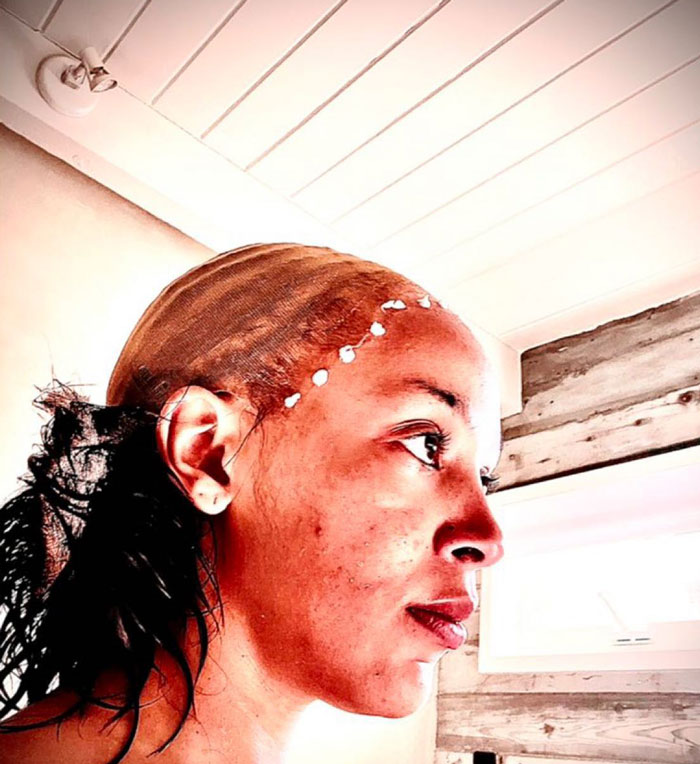 Doja Cat Posting Her Acne Problems