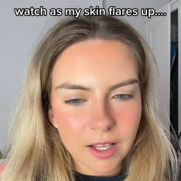 Woman's Face Starts Flaring Up Right Before Work, So She Films What It Looks Like To Raise Awareness