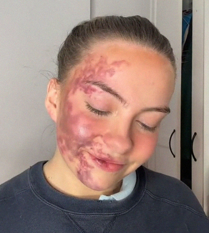 Woman's Face Starts Flaring Up Right Before Work, So She Films What It Looks Like To Raise Awareness