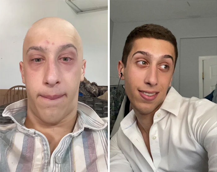 Right Pic Is 3 Months After Chemotherapy, Cancer Free And Feeling Amazing Physically!