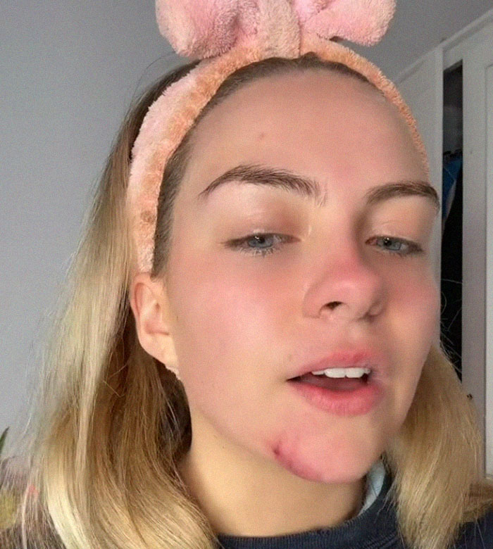 Woman's Face Starts Flaring Up Right Before Work, So She Films What It Looks Like To Raise Awareness