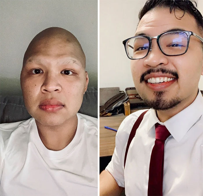 Hair Gains! After A Year Of Cancer, We're In Remission!