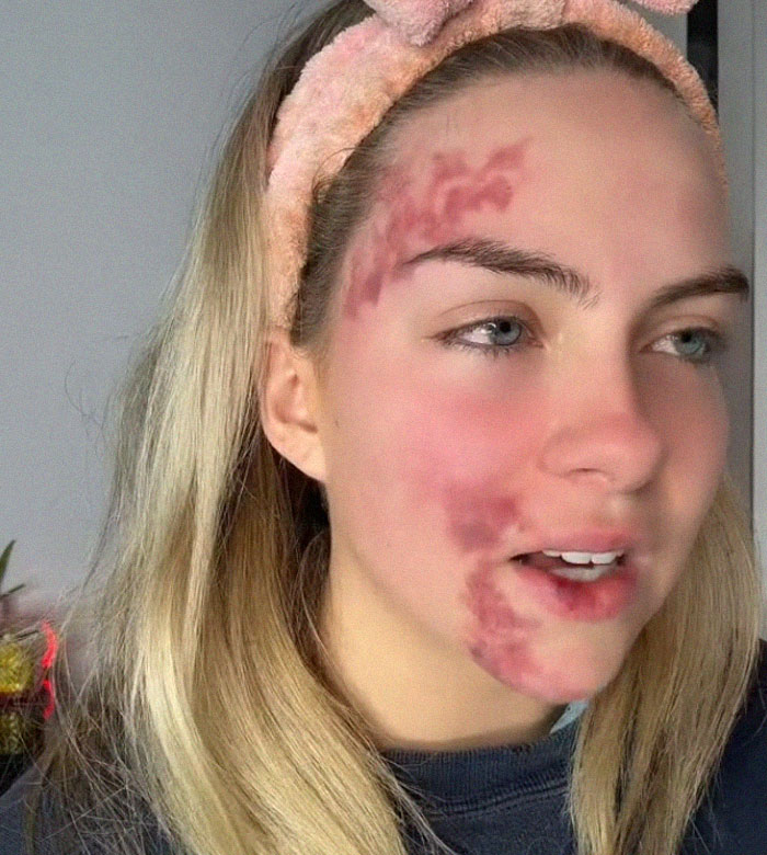 Woman's Face Starts Flaring Up Right Before Work, So She Films What It Looks Like To Raise Awareness