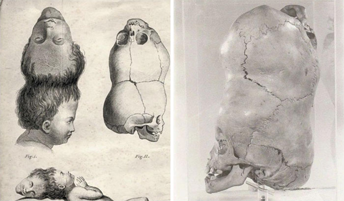In 1783 Bengal, A Boy Was Born With Two Heads And The Second Head Was Upside Down With The Neck Pointed Straight Up