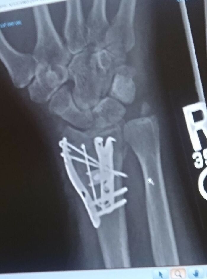 My Brilliant Sister On Christmas Day Decided To Ride Her Son's New Longboard. Let's Just Say It Did Not Go Well. Ouch! She Will Have A Bit Of Recovery Time Needed