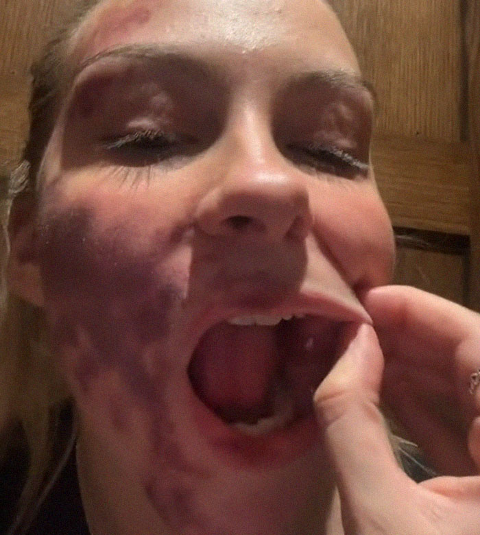 Woman's Face Starts Flaring Up Right Before Work, So She Films What It Looks Like To Raise Awareness