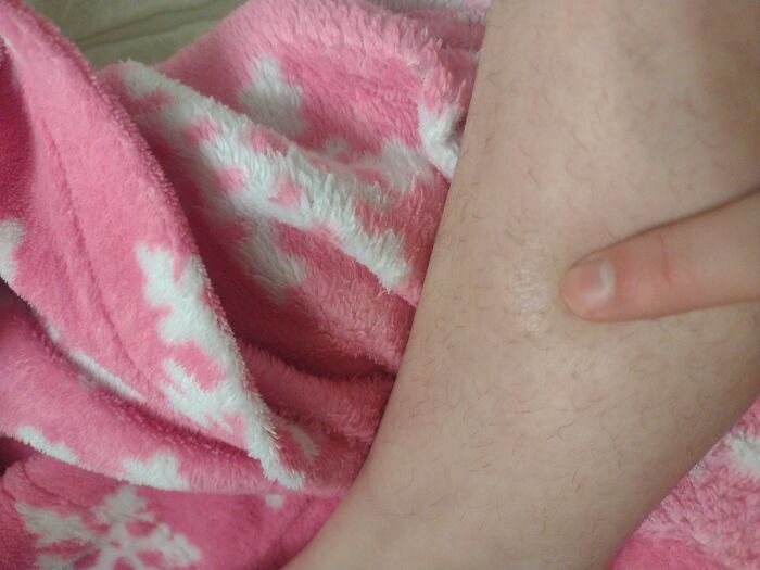 Not Showing Up Great Rn Because My Renard's Is Acting Up But I Dropped A Microwave Lasagna On My Leg And Got A Second Degree Burn 😋✌️