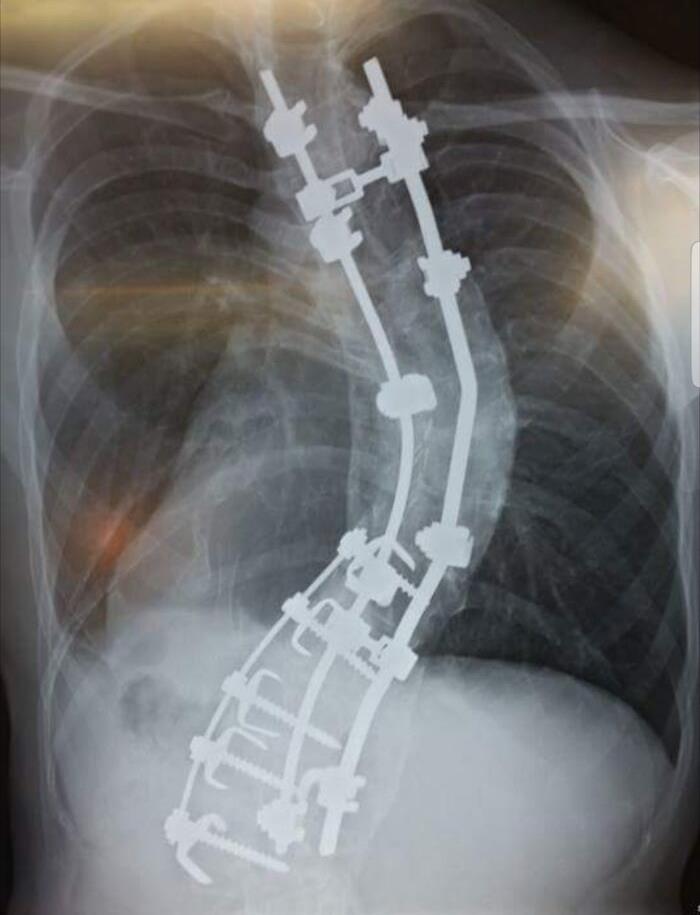 My Spine. I Went In For Surgery At 5'10", Came Out 6'2", I'm Supposed To Be 6'7"