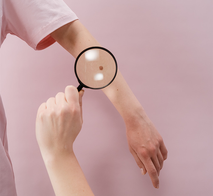 Doctor examining skin mole with magnifying glass emphasizing importance of second opinion stories in medical diagnosis.