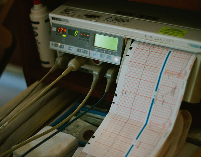Medical monitor displaying patient data with printed heart rate charts in a clinical setting for second opinion cases.