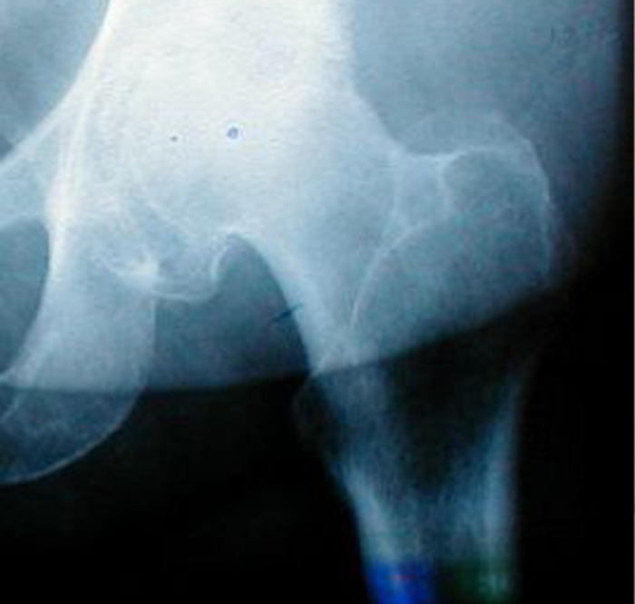 X-ray image of a hip joint showing bone structure relevant to doctors sharing second opinion stories.