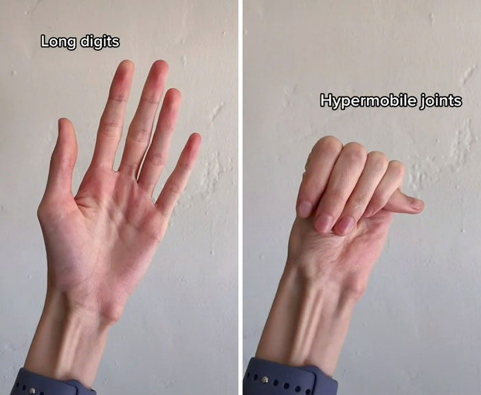 &ldquo;Are We Really That Scary To Y&rsquo;all?&rdquo;: Person With Marfan Syndrome Goes Viral With 1M Views For Calling Out Horror Writers&rsquo; Choice In Monster Design