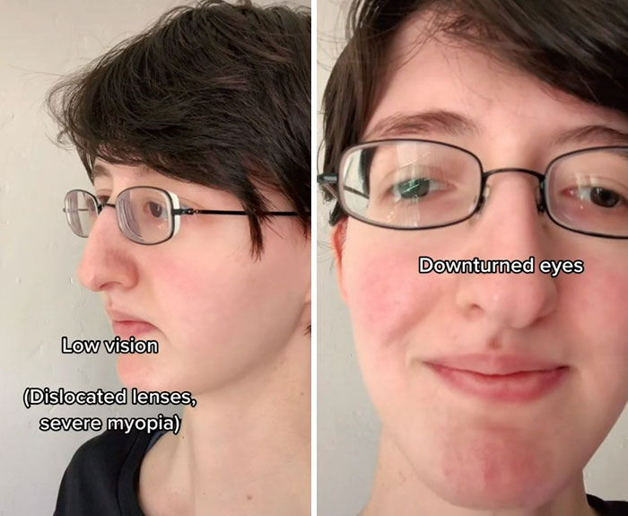 &ldquo;Are We Really That Scary To Y&rsquo;all?&rdquo;: Person With Marfan Syndrome Goes Viral With 1M Views For Calling Out Horror Writers&rsquo; Choice In Monster Design