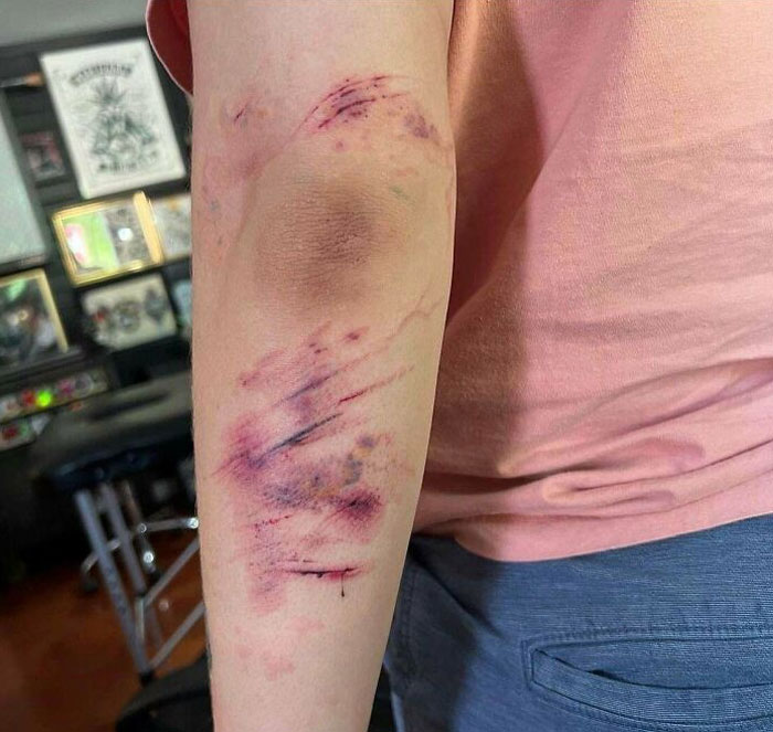 A poorly designed tattoo covers a person's forearm, appearing bruised and blotched.